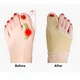 Mathiateur d'Hallux Valgus pour oignons séparateur de doigts pour orteils 2 pièces