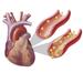 Heart with arteries showing cholesterol in one and plaque in the other. Poster Print by TriFocal Communications/Stocktrek Images (30 x 26)
