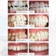Dispositif d'orthodontie dentaire pour adultes bretelles dentaires blanchiment des dents