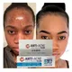 New Effective Acne Removal Cream Clears Blemish Pimple Remover Spot Safe Gentle Remove Acne Cream