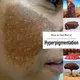 Whitening Face Cream Kojic Acid For Dark Skin Completely Even Skin Tone Decomposition Of Sunburn And