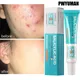 Salicylic Acid Acne Treatment Cream Repair Pimple Spots Deep Cleaning Pore Shrinking Anti-acne Oil