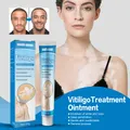 Vitiligo Removal Cream Fast Acting Leukoplakia Vitiligo Repair Cream Natural White Spot Soothing