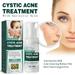 RunJia Cystic Salicylic For Face Advanced For Face Natural Cream And Pimple Creamt Effective Hormonal .100ml