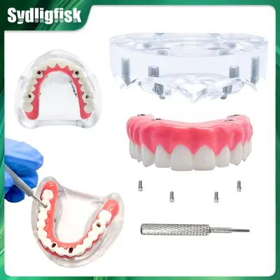 Dental Implant Teeth Model 4 Implant Overdenture Upper/Lower Jaw Restoration Removable Model Dentist