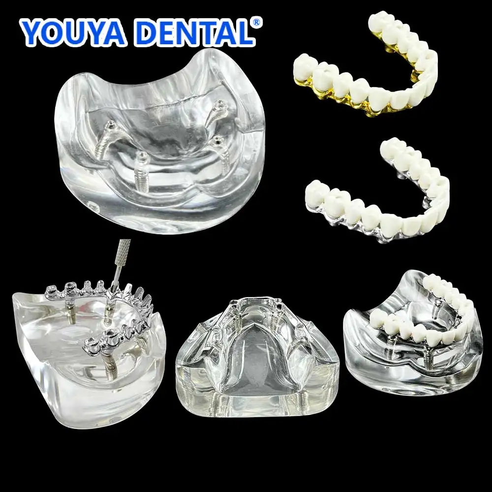 Mit 4 Implantaten Zahnimplantat-Restaurierungsmodell Oberkiefer mit 4 Implantaten Zahnarzt Schülererziehung Lehre Typodont-Implantat Image